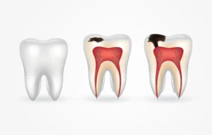 What Causes Tooth Decay