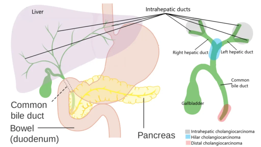 Bile Duct Cancer