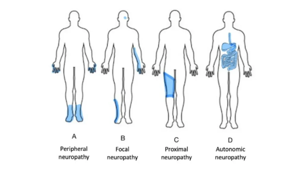 Four Types of Diabetic Neuropathy