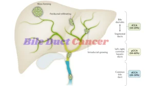 Bile Duct Cancer