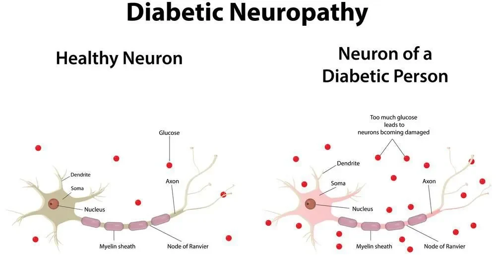 Diabetes Neuropathy