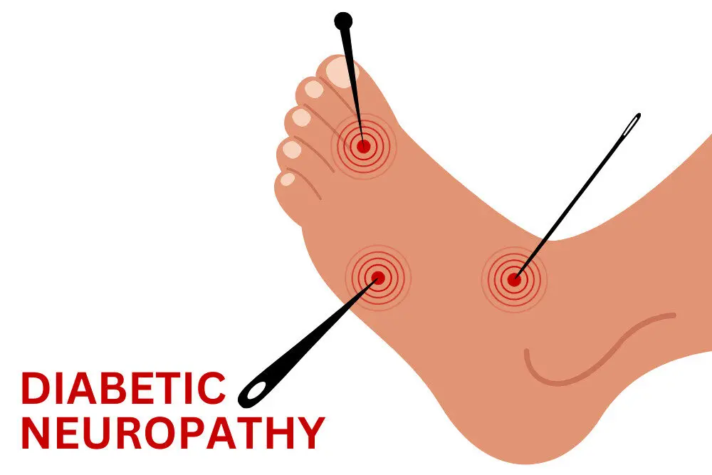 Diabetic Neuropathy