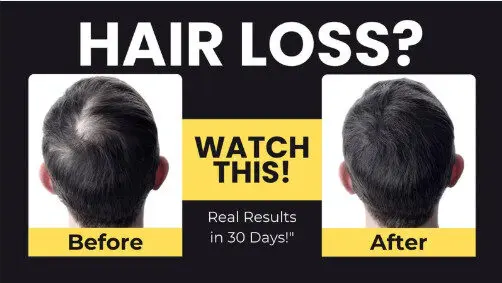 balding treatment product