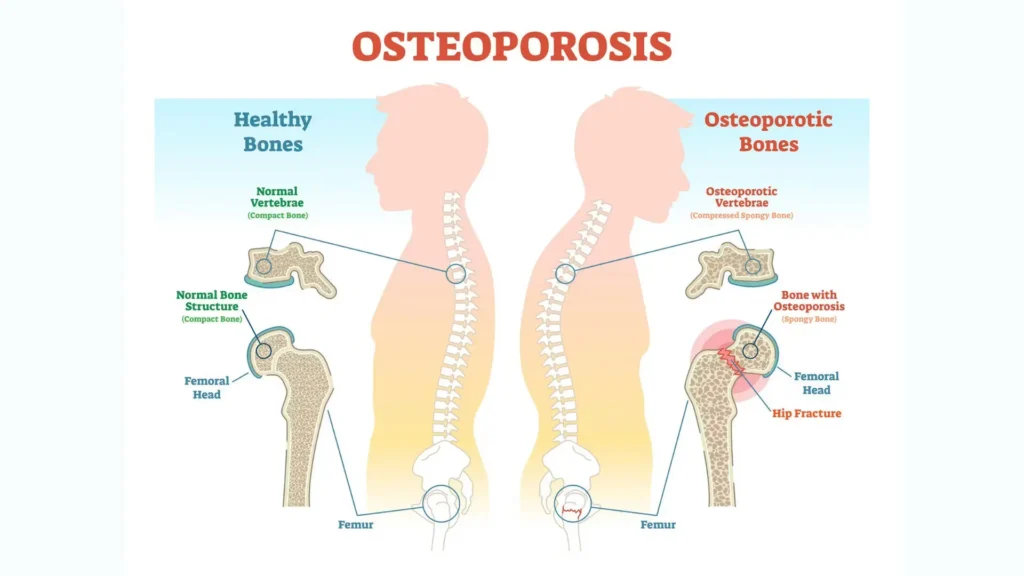 osteoporosis and calcium supplements
