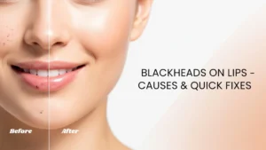 Blackheads on Lips
